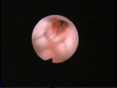 ANGIOMA SUBGLOTICO