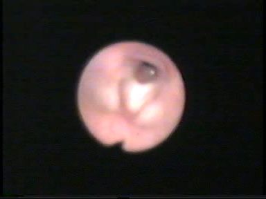 ESTENOSIS GLOTICA Y SUGLOTICA