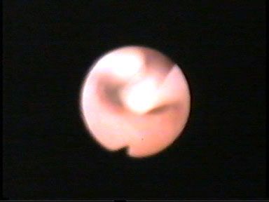 LARINGOMALACIA