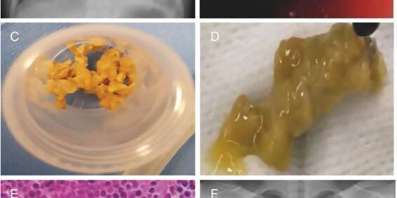 Refractory Inflammatory Plastic Bronchitis in Children