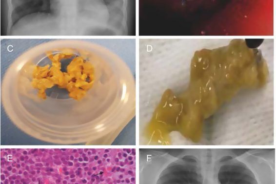 Refractory Inflammatory Plastic Bronchitis in Children